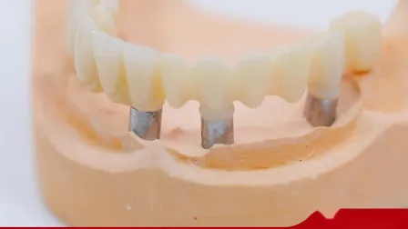 Dental Material Lab Implant Dental Lab Custom Metal Cast Partials with Mk1 Attachment From China Dental Lab