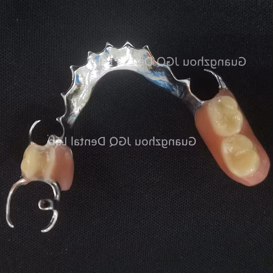 High Quality Removable Metal Framework Denture